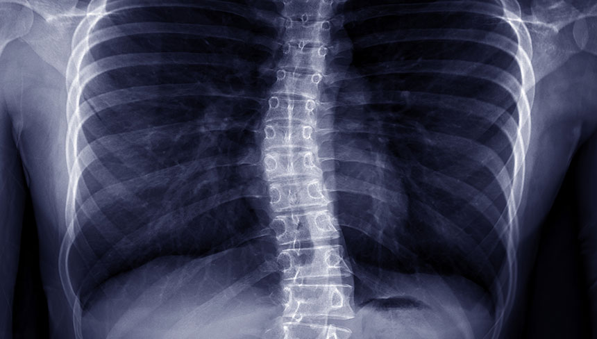 patient needing scoliosis treatment in Monterey Park