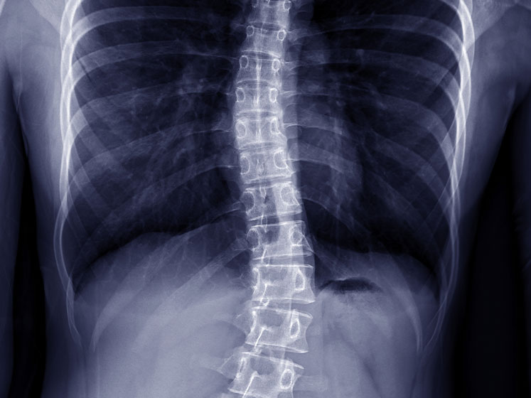 scoliosis treatment in Monterey Park