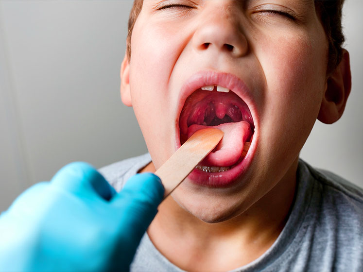 tonsillitis treatment in Monterey Park